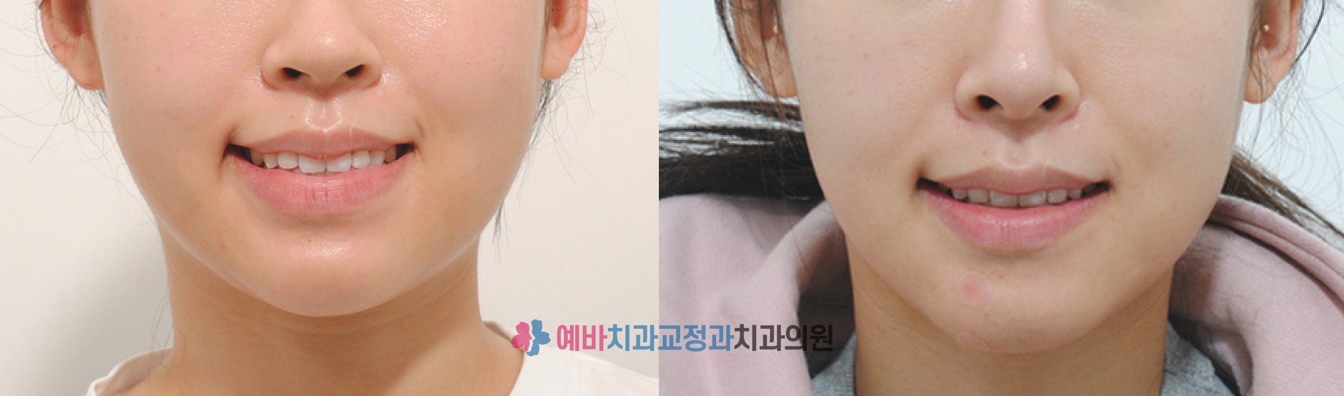 돌출입 교정 전/후