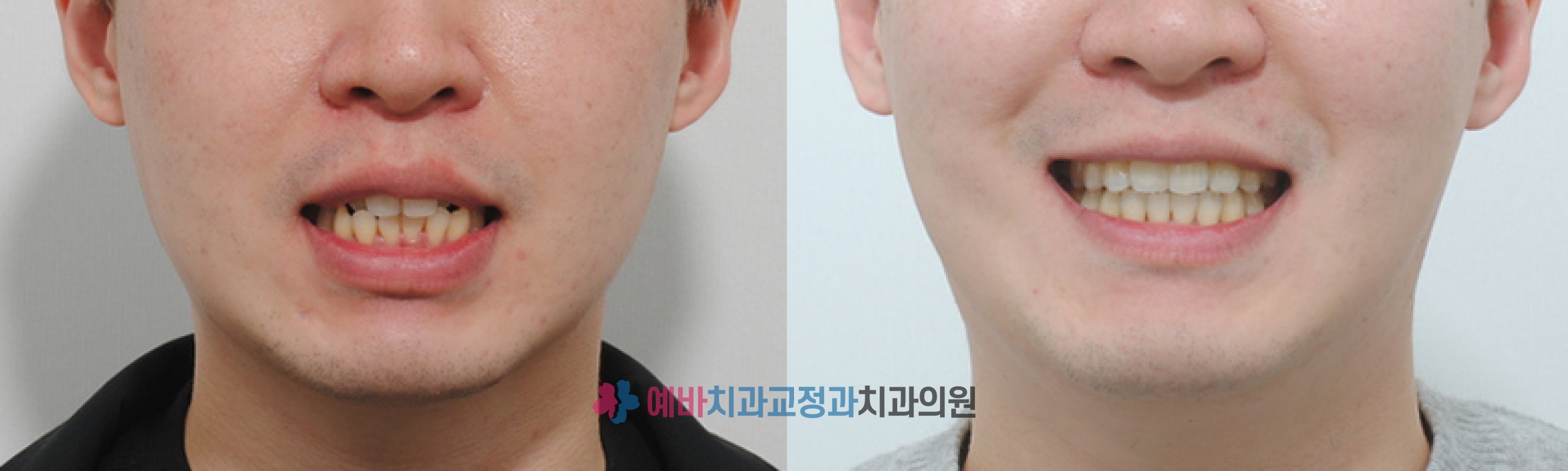 덧니 교정 전/후