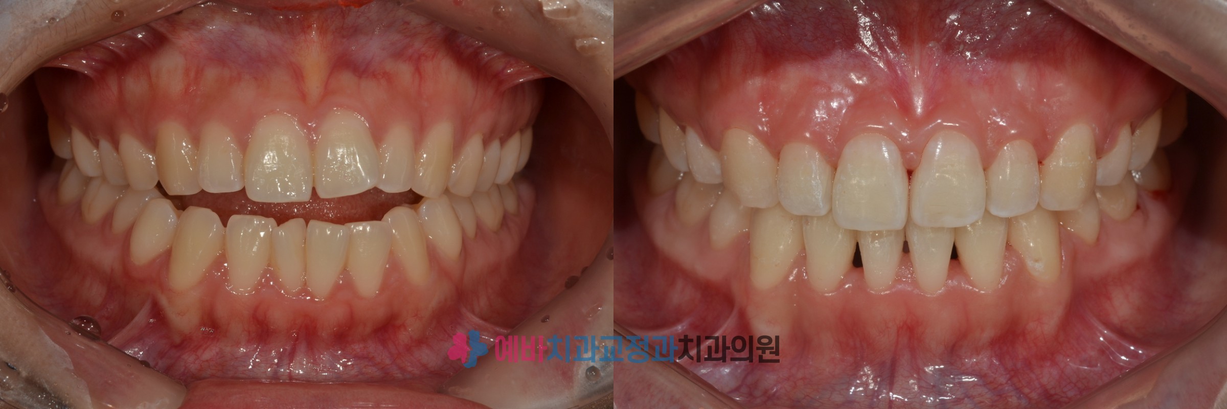개방교합 교정 전/후 전후사진