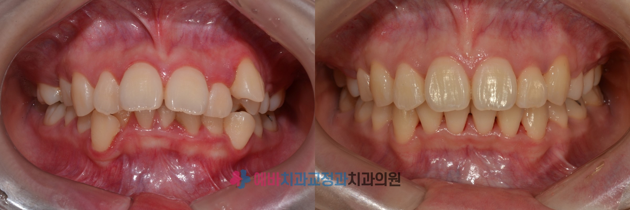 과개교합 교정 전/후