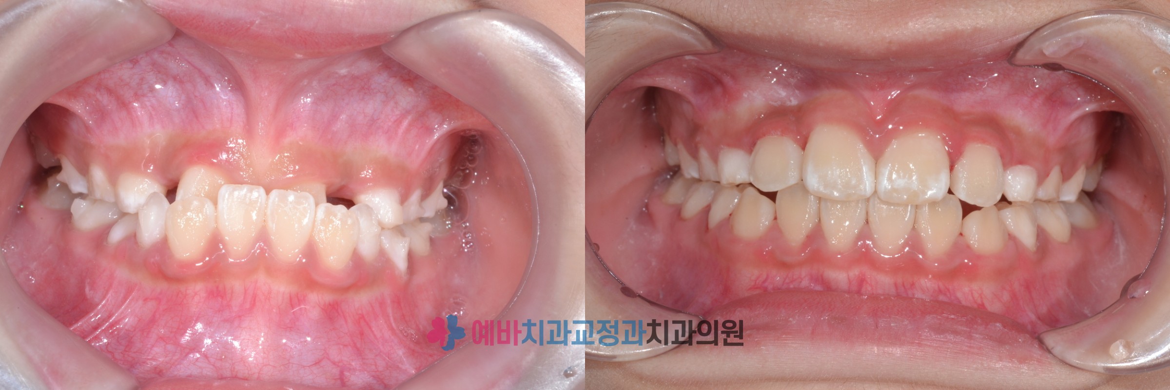성장교정 전/후