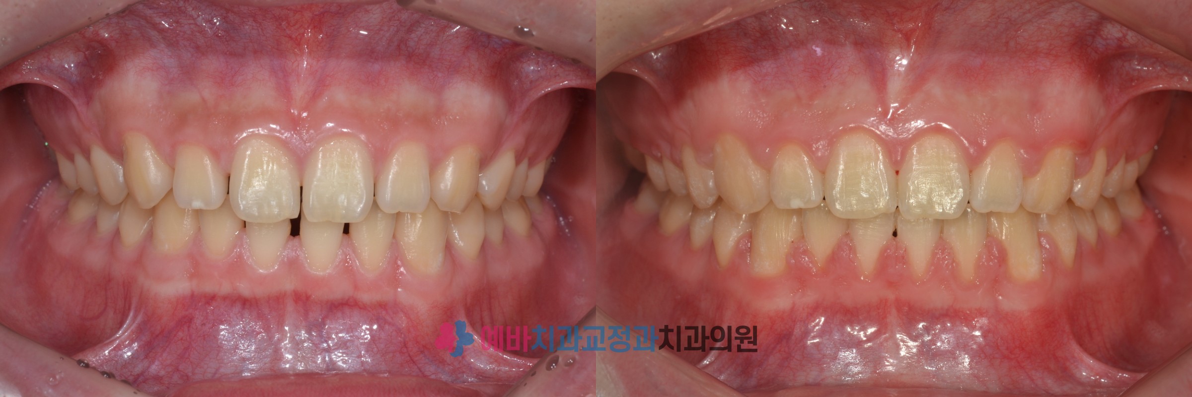 벌어진 치아 교정 전/후