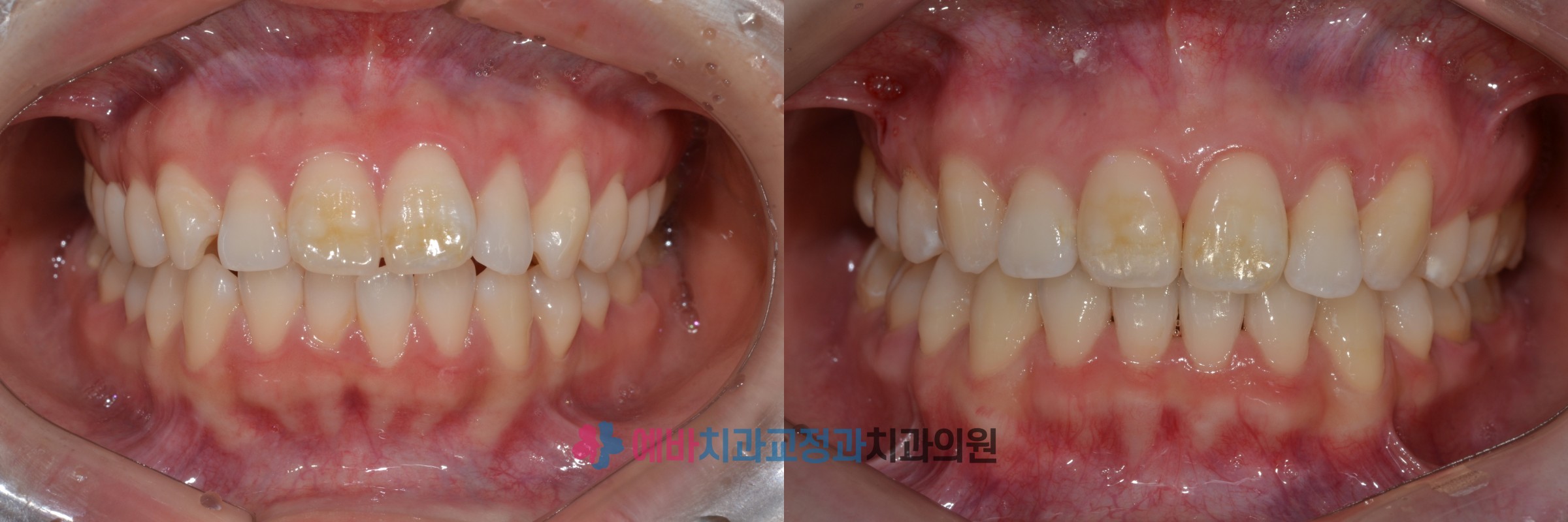 무턱, 뻐드러진치아 교정 전/후